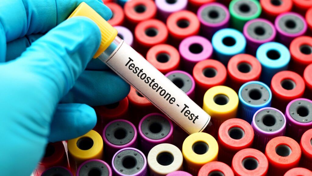 Proper testosterone testing requires morning samples, comprehensive panels including free testosterone and SHBG, and clinical correlation